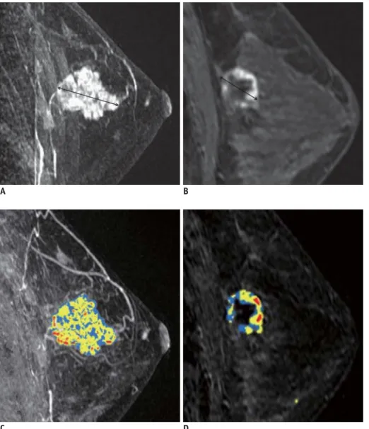 Fig. 3. Discordant case between  unidimensional and three dimensional  measurements is presented