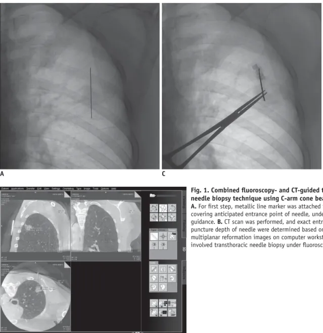 Fig. 1. Combined fl uoroscopy- and CT-guided transthoracic  needle biopsy technique using C-arm cone beam CT system