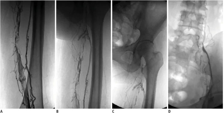 Fig. 1. Complete lysis in 33-year-old woman with 3-week history of swelling of left leg after cesarean section (venograms with  patient in prone position)