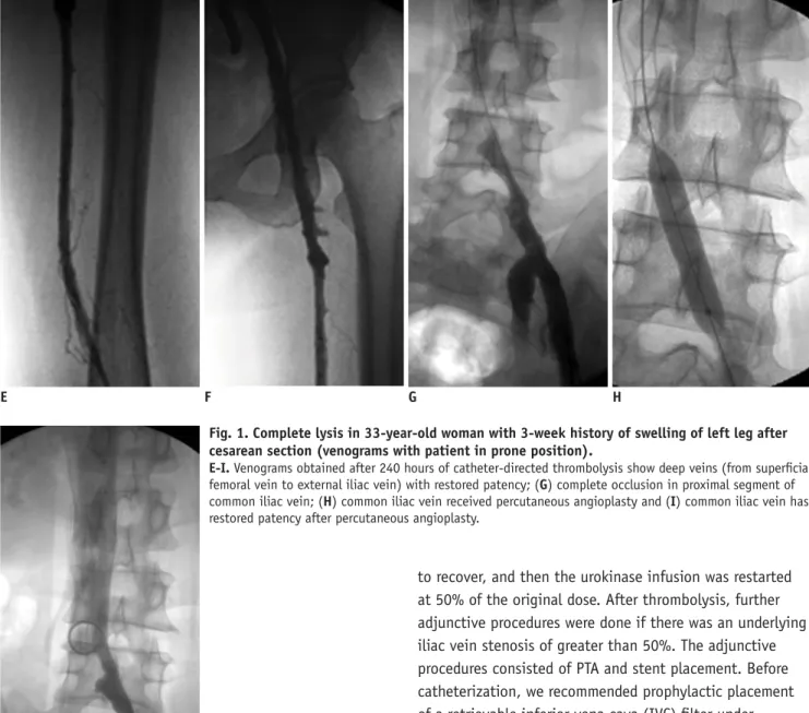 Fig. 1. Complete lysis in 33-year-old woman with 3-week history of swelling of left leg after  cesarean section (venograms with patient in prone position)