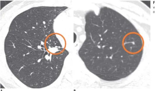 Fig. 2.  Examples of isolated (A) and  vascular-attached (B) nodules detected by  computer-aided diagnosis system.