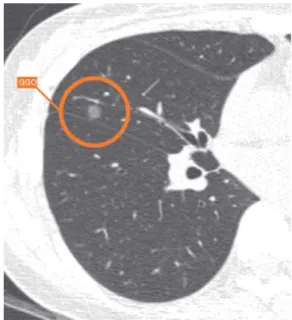 Fig. 4. Example of ground-glass nodule detected by computer- computer-aided diagnosis system.