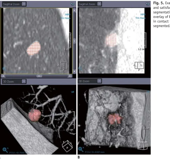 Fig. 5.  Examples of excellent (A)  and satisfactory but not perfect (B)  segmentation in nodule volumetry