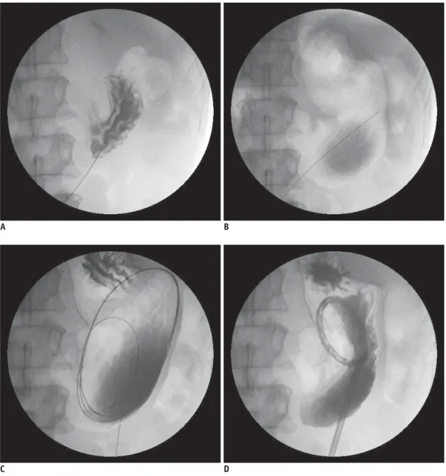 Fig. 1. Modifi ed radiology-guided percutaneous gastrostomy technique.