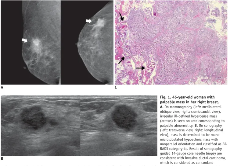 Fig. 1. 46-year-old woman with  palpable mass in her right breast. 