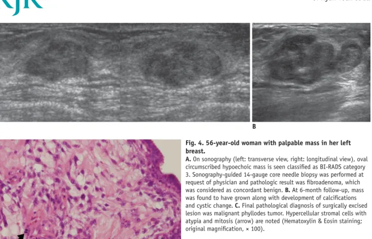 Fig. 4. 56-year-old woman with palpable mass in her left  breast. 