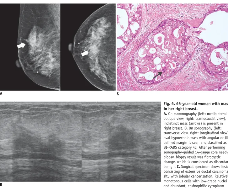Fig. 6. 65-year-old woman with mass  in her right breast. 