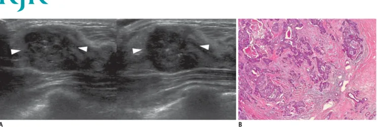 Fig. 8. 40-year-old woman with palpable mass in her left breast. 