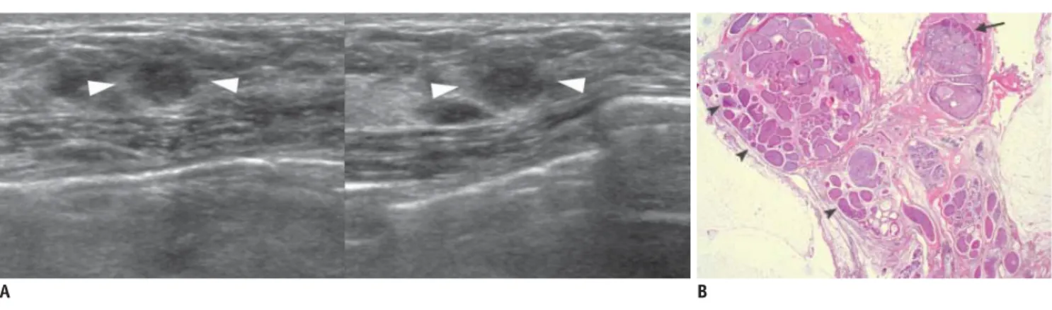 Fig. 9. 49-year-old woman with mass in her left breast. 