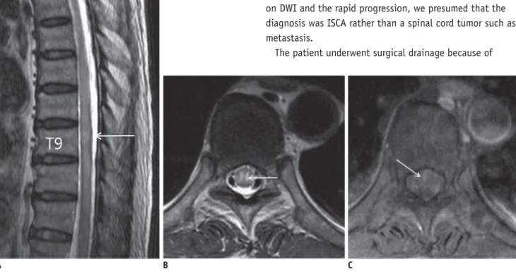 Fig. 1. Intramedullary spinal cord abscess in 78-year-old man.