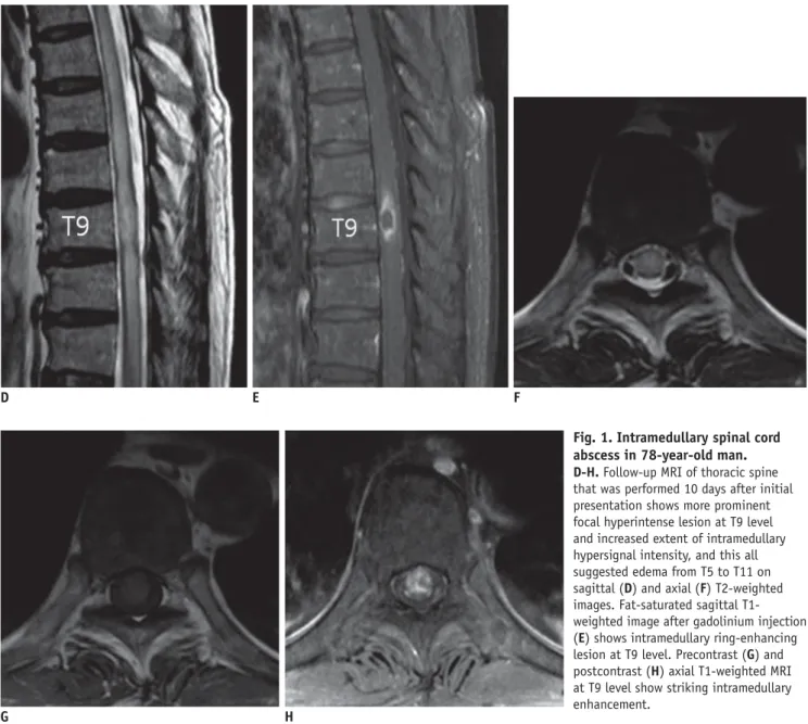 Fig. 1. Intramedullary spinal cord  abscess in 78-year-old man.