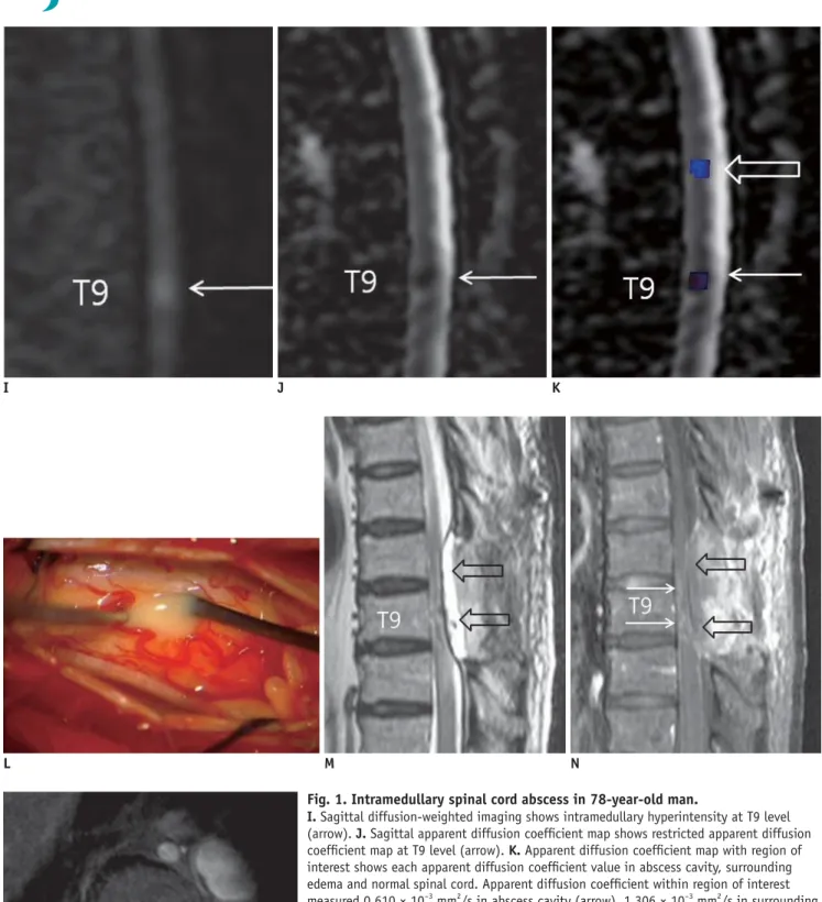 Fig. 1. Intramedullary spinal cord abscess in 78-year-old man.