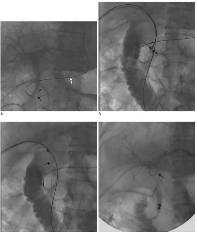 Fig. 1. Percutaneous transhepatic release of impacted lithotriptor basket and its fractured traction wire in 66-year-old male with  common bile duct stone.