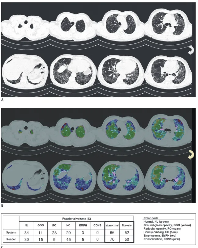 Fig. 1. 50-year-old man who had pathologically proven usual interstitial pneumonia.