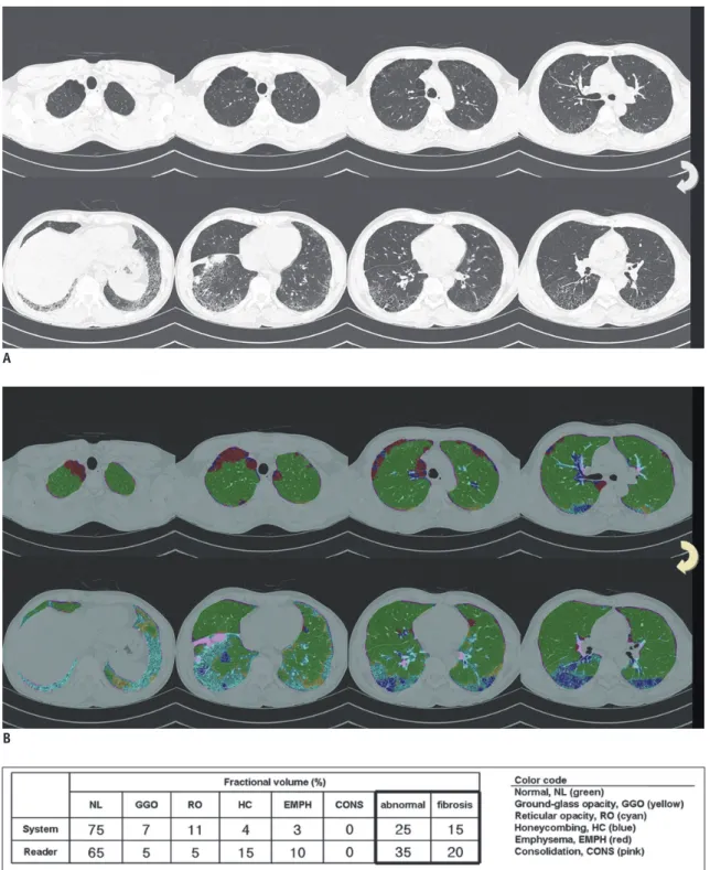 Fig. 3. 47-year-old man who had pathologically proven nonspecific interstitial pneumonia.