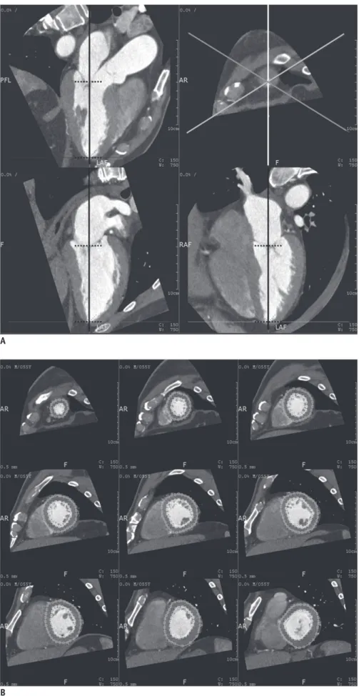 Fig. 1. Left ventricular volume of twenty  phases’ estimation. 