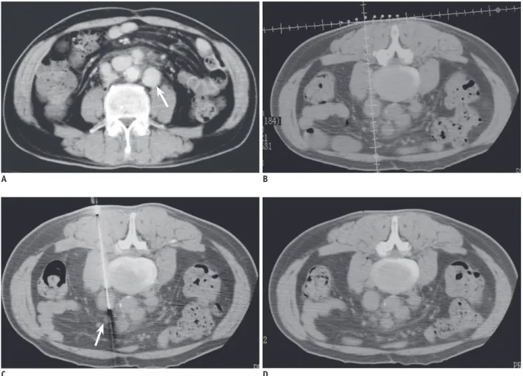 Fig. 1. 53-year-old man with paraaortic lesion.