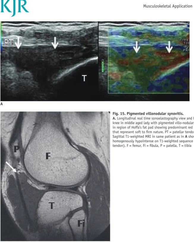 Fig. 15. Pigmented villonodular synovitis.