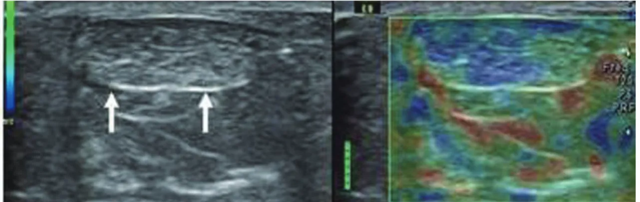 Fig. 1.  Transverse real time sonoelastography view and B mode image of distal Achilles tendon in healthy asymptomatic young adult, and it  shows distal Achilles tendon (arrows) with predominant blue areas representing hardness.