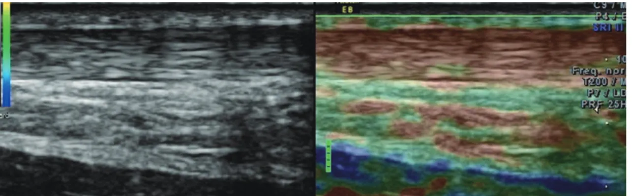 Fig. 3.  Longitudinal real time sonoelastography image shows distal Achilles tendon in symptomatic geriatric patient with predominant red areas  indicating softness.