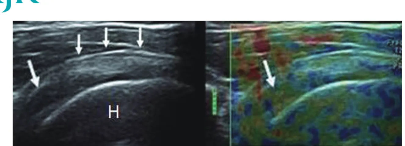 Fig. 7. Elbow tuberculosis.