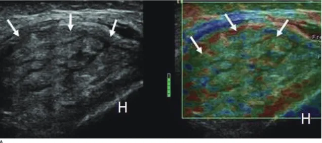 Fig. 12. Triceps myositis.
