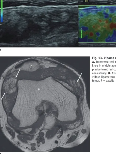 Fig. 13. Lipoma arborescens.