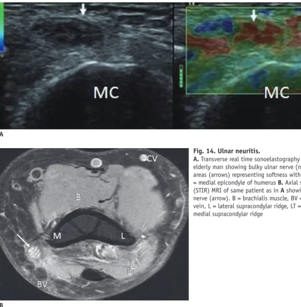 Fig. 14. Ulnar neuritis.