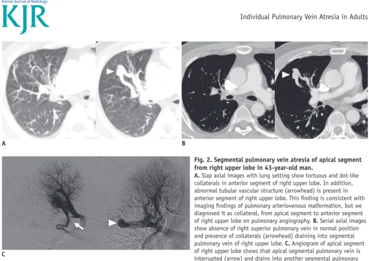 Fig. 2. Segmental pulmonary vein atresia of apical segment  from right upper lobe in 43-year-old man.