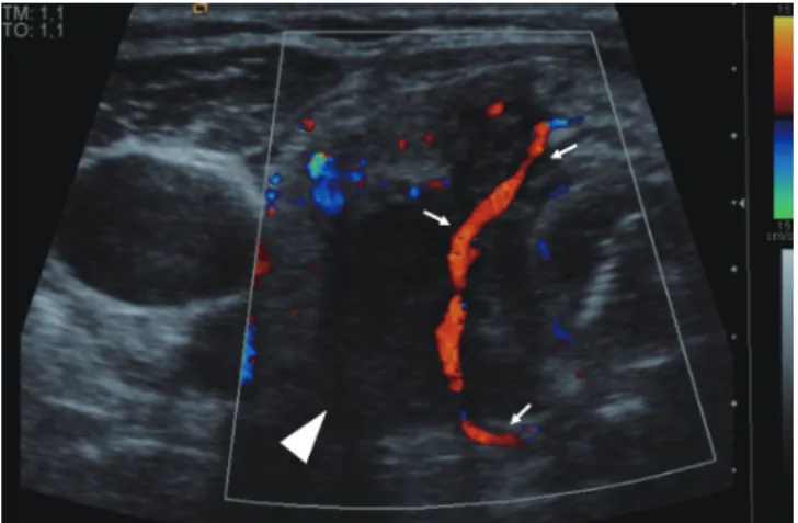 Fig. 1. Patient who presented with poorly-differentiated  papillary thyroid carcinoma