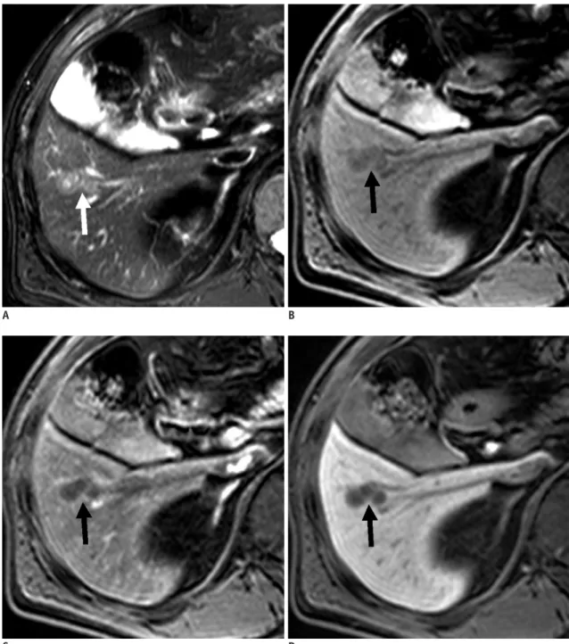 Fig. 4. 58-year-old man with colon cancer and focal eosinophilic abscess confirmed by percutaneous sonography-guided biopsy  (differential count of eosinophils in peripheral blood, 2%) in liver (false-negative lesion)