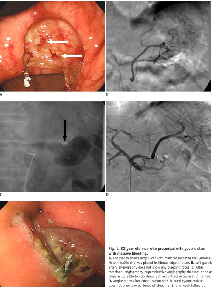 Fig. 1. 82-year-old man who presented with gastric ulcer  with massive bleeding. 