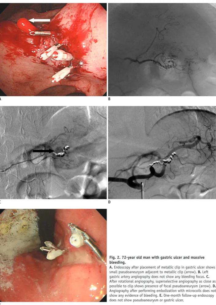 Fig. 2. 72-year old man with gastric ulcer and massive  bleeding. 
