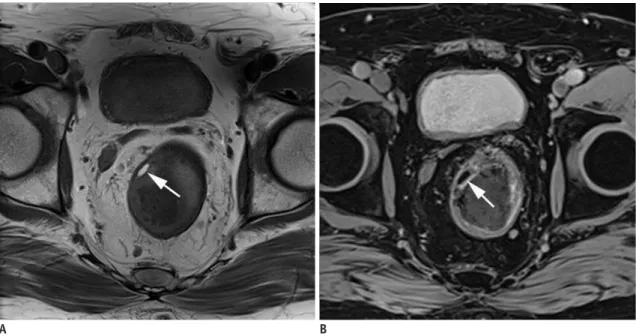 Fig. 2. Rectal lipoma in 74-year-old man. 