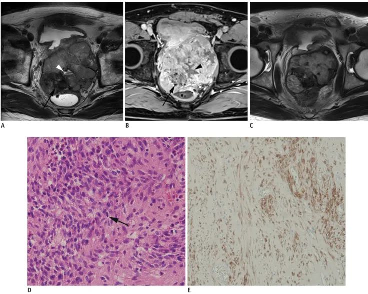 Fig. 6. Rectal gastrointestinal stromal tumor in 53-year-old man.
