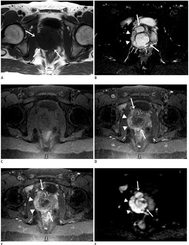 Fig. 1. Prostatic stromal sarcoma in 26-year-old man.