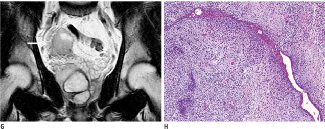 Fig. 1. Prostatic stromal sarcoma in 26-year-old man.