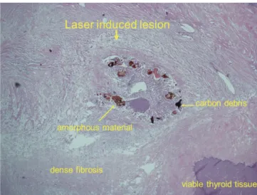 Fig. 11. Microscopic changes occurring in benign thyroid  nodule resected two years after laser ablation