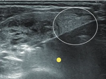 Fig. 5. US image showing trans-isthmic approach.  This transverse  US image shows electrode in its entirety, thyroid nodule, and possible  location of recurrent laryngeal nerve (small yellow circle)