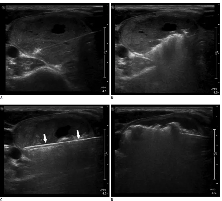 Fig. 7. Sequential US images of moving shot technique showing complete ablation of nodule margins
