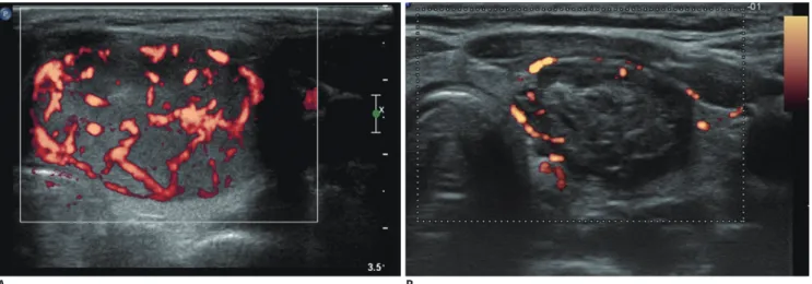 Fig. 8. Transverse US images of well-ablated thyroid nodule, before (A) and 12 months after (B) radiofrequency ablation, showing  size reduction, decreased echogenicity, and lack of internal vascularity.