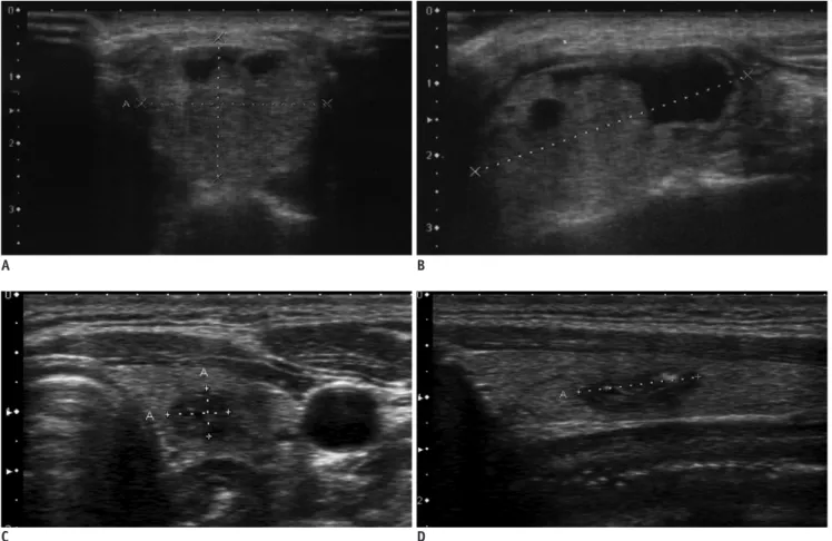 Fig. 10. Transverse and longitudinal US images showing marked shrinkage of ablated nodule