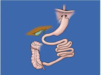 Fig.  1.  Vertical  sleeve  gastrectomy  without  duodenal  switch