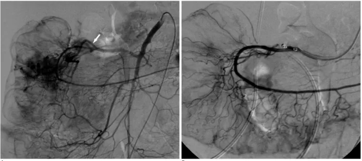 Fig. 1. 54-year-old woman presented with acute melena and hemodynamic instability.  Emergent endoscopy was performed and revealed  bleeding ulcer over ascending colon