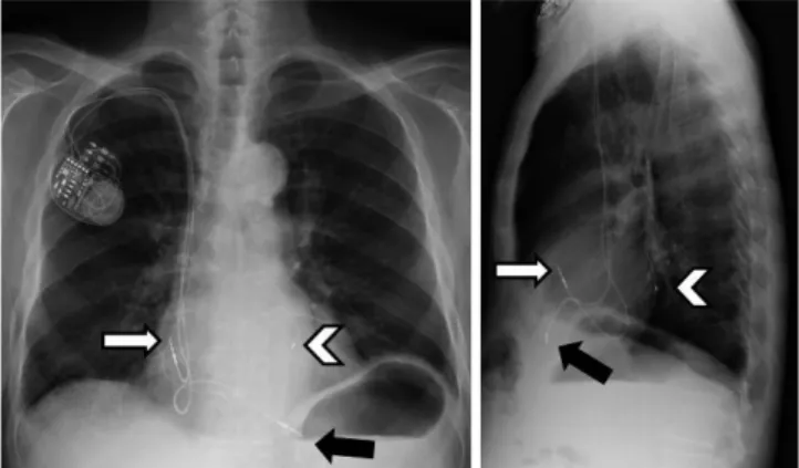 Fig. 4. 57-year-old female patient with two-lead bichamber  pacemaker (DDD). Preferred tip position is right atrial appendage  (white arrows) and apex of right ventricle (black arrows), as seen  on PA and lateral chest radiographs.