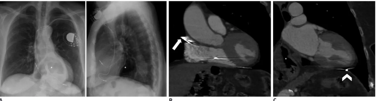 Fig. 21. 84-year-old female patient with DDD pacemaker suffering from diaphragmatic stimulation