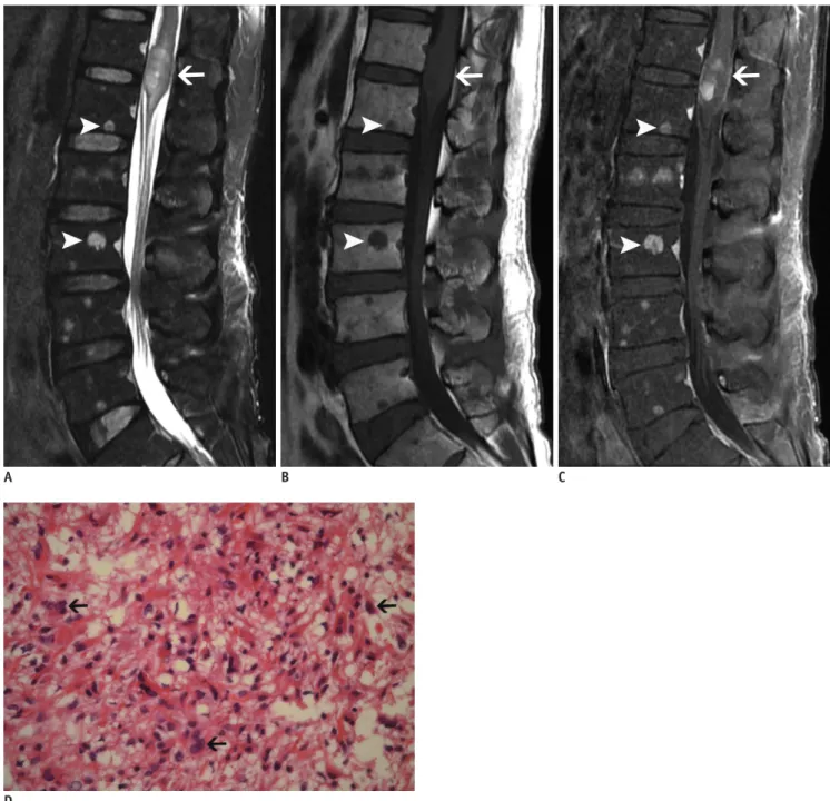 Fig. 1. Bone metastasis identified concurrently with primary spinal cord astrocytoma.