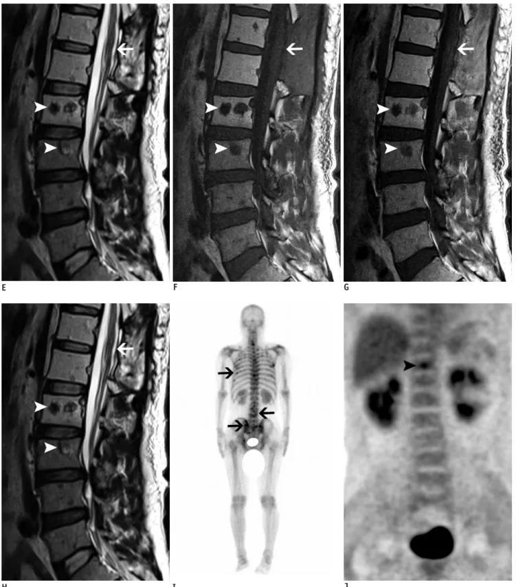 Fig. 1. Bone metastasis identified concurrently with primary spinal cord astrocytoma.