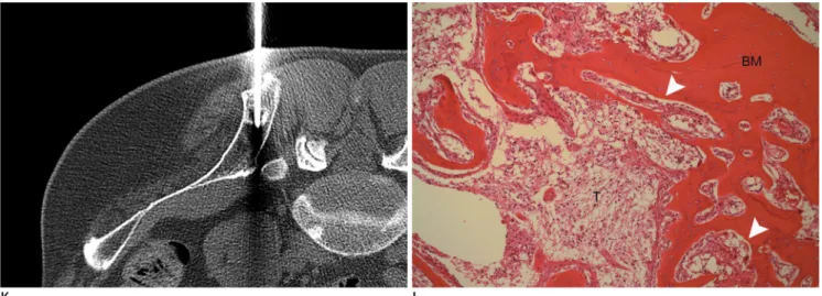 Fig. 1. Bone metastasis identified concurrently with primary spinal cord astrocytoma.