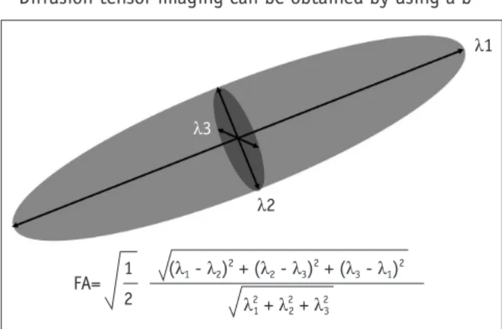 Fig. 1. Calculation of fractional anisotropy.  Largest vector of  diffusion ellipsoid is eigenvector 1 and its value is λ1